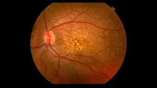 Exploring Alternative Treatments for Age-Related Macular Degeneration