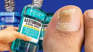 LISTERINE is able to remove NAIL FUNGI 🔥 You will never have nail fungus again!