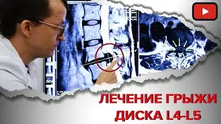 TREATED L4-L5 DISC HERNIATION