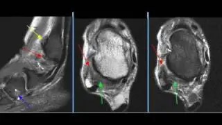 MRI Ankle Case 11