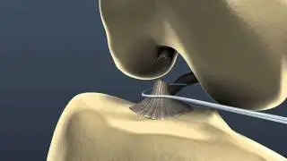 LARS™ ACL - Surgical Technique