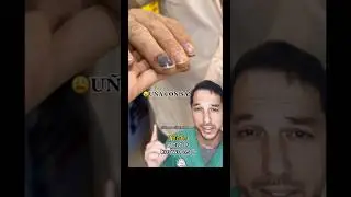 Blood under the nail can be drained 
