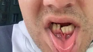 Пете сломали челюсть / готовим ему кашки блендером