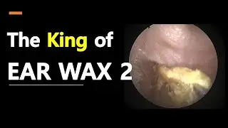 The King of EARWAX 2
