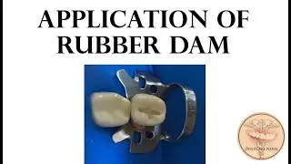 Application of Dental dam - Use of Rubber Dam in Dentistry
