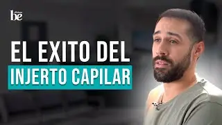 🌟 Carlos Javier y su Éxito con el Injerto Capilar en Clínicas Be, Granada | Testimonio Real 🌟