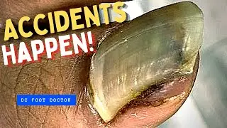 Accidents Happen! Big Toe Injury