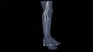 Peripheral Artery Disease (PAD)
