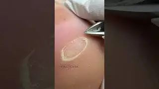Обработка мозоли, срез, шлифовка 