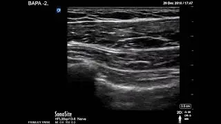 Pectoral muscles scanning