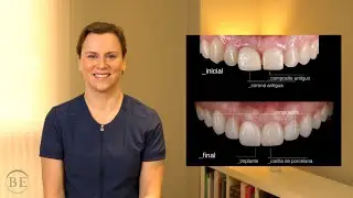 Implantes dentales: casos
