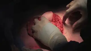 Delayed Latissimus Dorsi Flap Breast Reconstruction