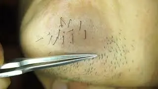 Hair removal asmr pull out with Tweezers  Satisfying pull out beard 10min 202409a