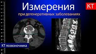Basic measurements in degenerative spinal diseases
