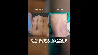 Before and After of Mini Tummy Tuck with 360 degree Lipocontouring 