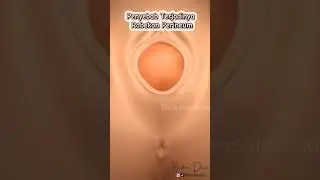 Penyebab Robekan Perineum #edukasikehamilan #robekanperineum
