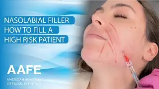 Nasolabial Filler: How to Fill a High Risk Patient