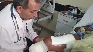 Fisioterapia na fratura de fêmur e amputação transtibial @antoniovitalsampol4984