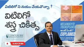 విటిలిగో | ల్యూకోడెర్మా | తెల్ల మచ్చలు | మెలనోసైట్ ట్రాన్స్ప్లాంటేషన్ శస్త్ర చికిత్స  | VITILIGO