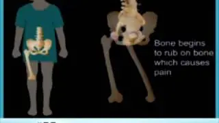 Reasons For Total Hip Replacement