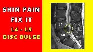 How to fix Shin pain due to lumbar L4 - L5 disc bulges