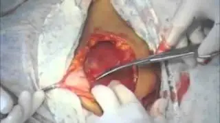 Caesarean section.