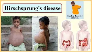 Hirschsprung's disease