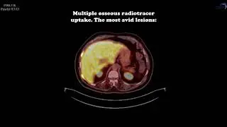 PSMA PET/CT F-18 Case 11