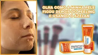 AZELAN SERÁ QUE TENHO ALERGIA? RESULTADO DO MEU PEELING