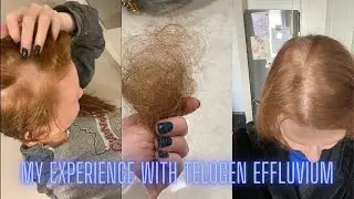 My Experience with Telogen Effluvium