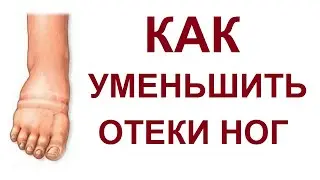 Отеки ног  Почему отекают ноги Как устранить отечность ног