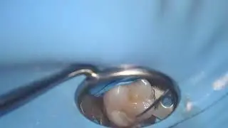 Occlusal Composite Filling Extaro Microscope