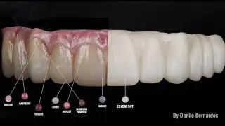 MiYo - Transformando a zircônia monolítica