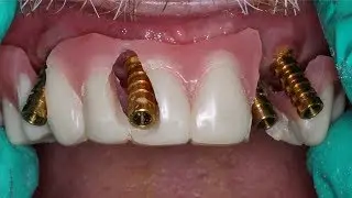 Hopeless Implants - What Can You Do?
