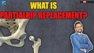 What is Partial Hip Replacement@saqshamortho1346