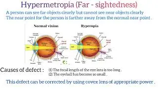 What is hypermetropia? #viral #youtubeshorts #shortsvedioviral