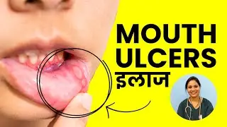 Mouth Ulcers Treatment in Hindi - Ulcer का इलाज कैसे करें?