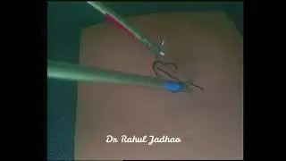 Smiley needle technique of laparoscopic knot tying
