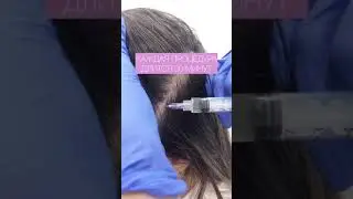 Лечение и профилактика выпадения волос