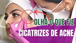 CICATRIZES DE ACNE COM BIOESTIMULADOR COLAGENO