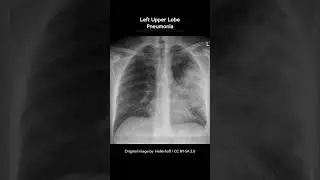 Lobar Pneumonia Chest X-rays 