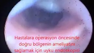 Horlama apne ameliyatı