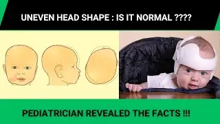 HOW TO PREVENT FLAT HEAD BY PEDIATRICIAN?UNEVEN HEAD SHAPE IN BABIES - CAUSES & TREATMENT -
