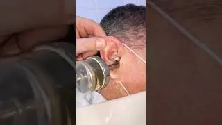 удаление серной пробки