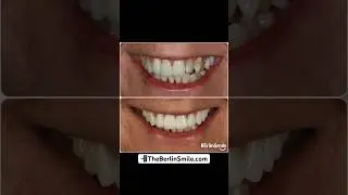 Using 10 porcelain veneers, we enhanced her smile and achieved greater symmetry. ✅ #shorts