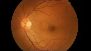 Stargardt Disease - Children and low Vision