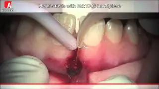 HEMOSTASIS Fotona Lightwalker NdYAG laser