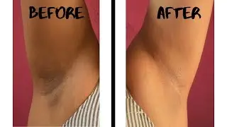 Instant Underarm Whitening DIY Recipe At Home 100% Natural