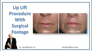 Lip Lift Procedure: It's easier than you think