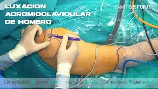 LUXACION ACROMIOCLAVICULAR DE HOMBRO (AC Joint dislocation - Anatomic reconstruction)